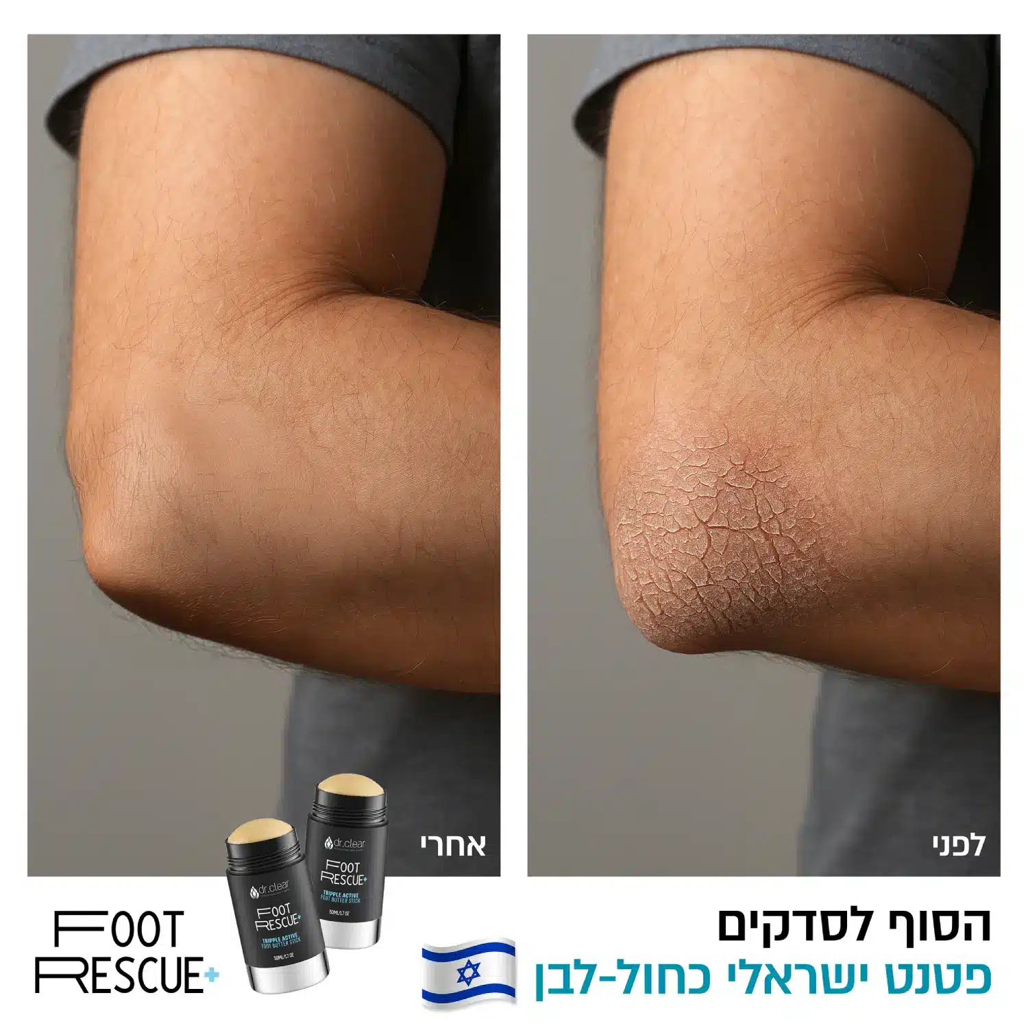 תוצאות של לפני השימוש ואחרי השימוש בפוט רסקיו במרפקים יבשים וסדוקים